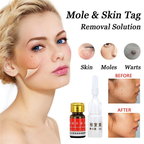 Painless Mole Skin Dark Spot Removal Face Wart Tag Freckle Removal Cream Oil Mole Skin Tag Removal Solution
