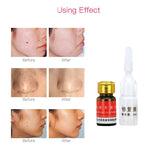 Painless Mole Skin Dark Spot Removal Face Wart Tag Freckle Removal Cream Oil Mole Skin Tag Removal Solution