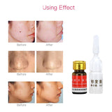 Painless Mole Skin Dark Spot Removal Face Wart Tag Freckle Removal Cream Oil Mole Skin Tag Removal Solution